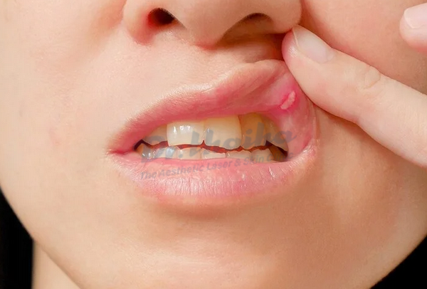 Bệnh lở miệng: Nguyên nhân, dấu hiệu và cách điều trị