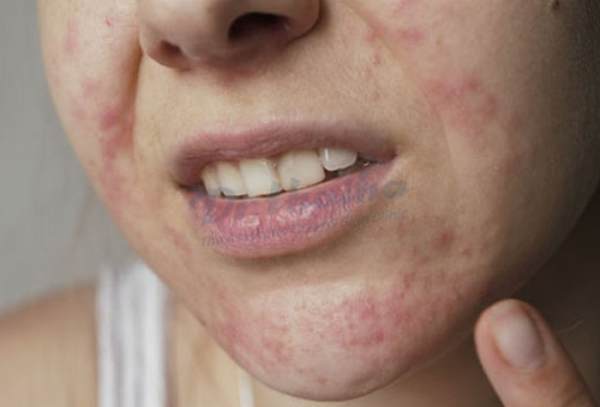 Nấm da mặt: nguyên nhân, dấu hiệu và cách chữa trị an toàn