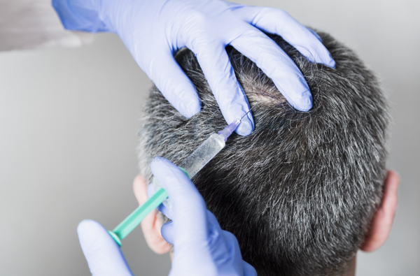 Liệu trình tiêm meso kích thích mọc tóc an toàn và hiệu quả