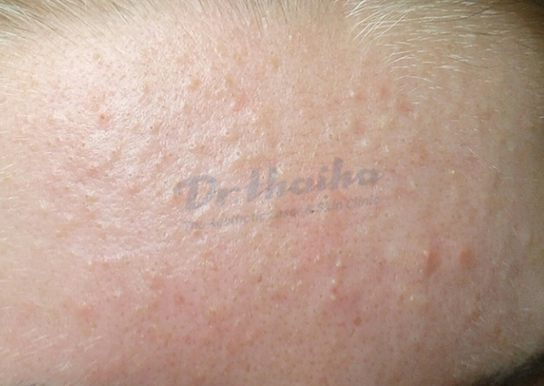 Mụn ẩn dưới da: Nguyên nhân, dấu hiệu và cách chữa trị