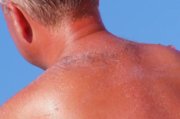Cháy nắng và ung thư da có liên quan đến nhau không?