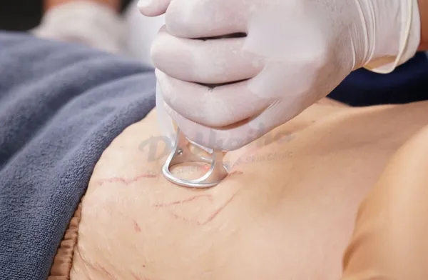 Chi phí và cách điều trị rạn da sau sinh