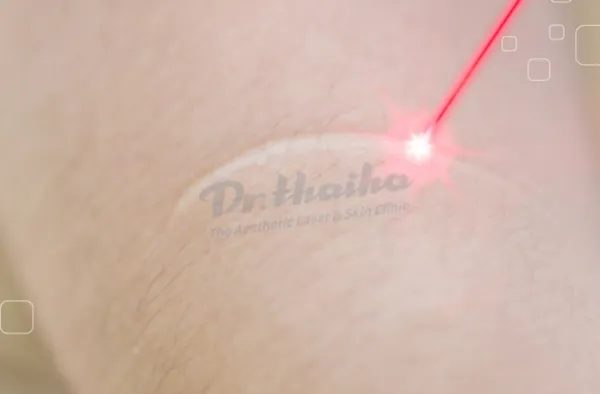 Laser trị sẹo lồi là gì? Bắn laser có hiệu quả không?