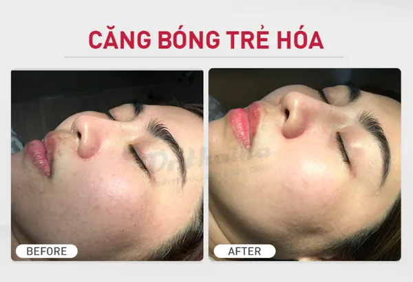 Profhilo tiêm B.A.P là gì? Có tác dụng gì không?