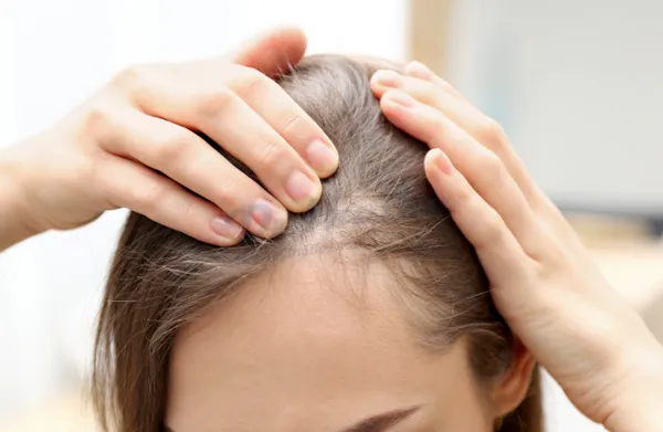 Rụng tóc sau sinh cần bổ sung vitamin gì? Chuyên gia chia sẻ
