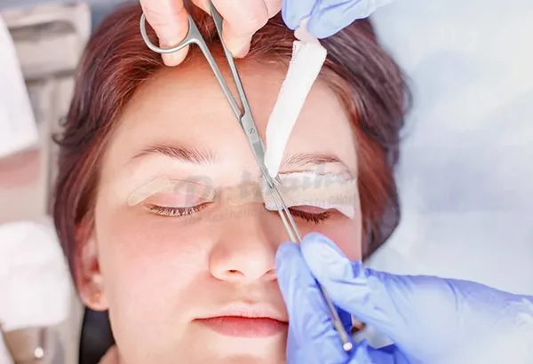 Sẹo lồi mí mắt: Nguyên nhân và cách điều trị hiệu quả
