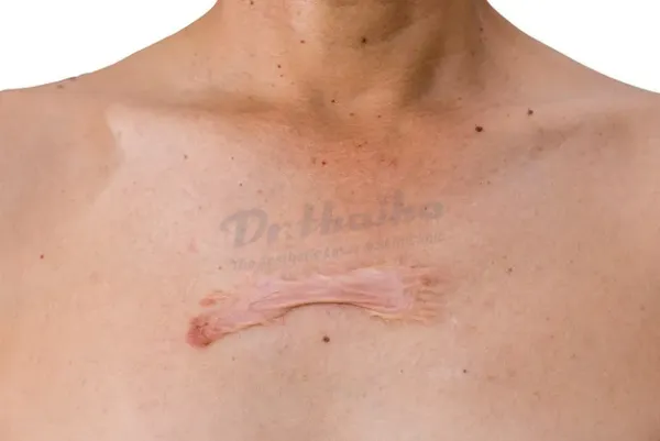 Sẹo lồi ở ngực: Nguyên nhân và cách điều trị hiệu quả