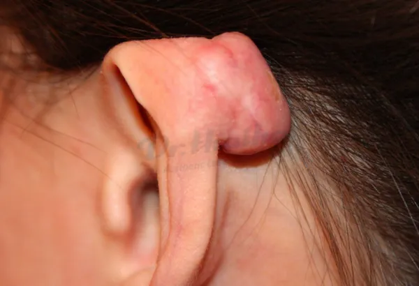 Sẹo lồi ở tai: Nguyên nhân và cách chữa trị hiệu quả