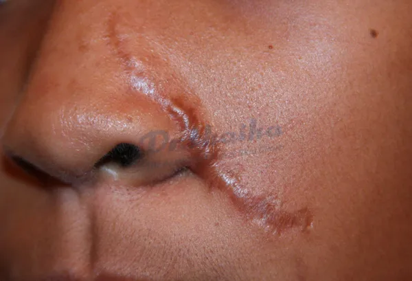 Sẹo lồi trên mặt: Nguyên nhân, dấu hiệu và cách điều trị hiệu quả