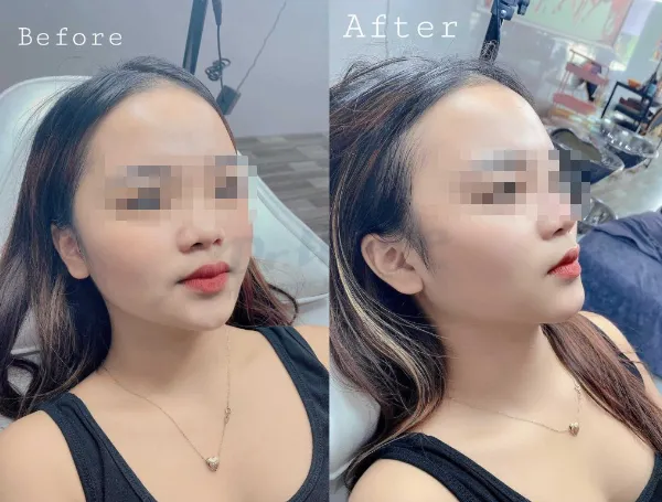 Tiêm botox hàm bao lâu hiệu quả? Hiệu quả trong bao lâu?