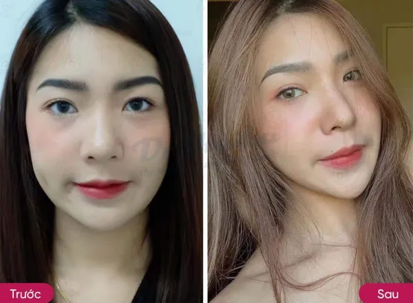 Tiêm botox sau bao lâu có tác dụng? Chuyên gia chia sẻ