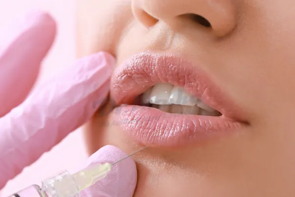 Tiêm filler môi có an toàn không? Tác dụng phụ và biến chứng có thể gặp