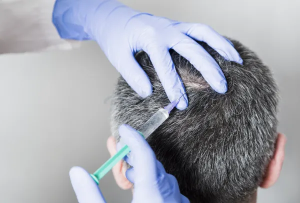 Tiêm meso trị rụng tóc là gì? Cần thực hiện ở cơ sở như thế nào?