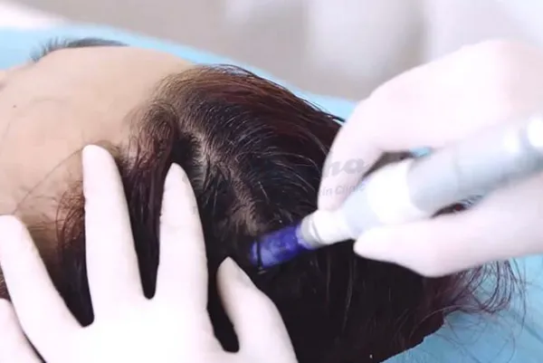 Tóc rụng sau sinh và cách điều trị bạn cần biết