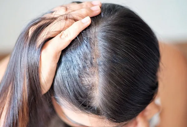 Tóc thưa, tóc mỏng: Nguyên nhân và cách cải thiện độ dày của tóc