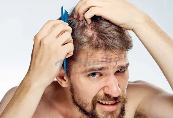 Tóc thưa, tóc mỏng: Nguyên nhân và cách cải thiện độ dày của tóc