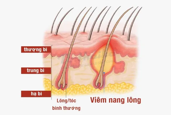 Viêm nang lông: Nguyên nhân, dấu hiệu và cách điều trị