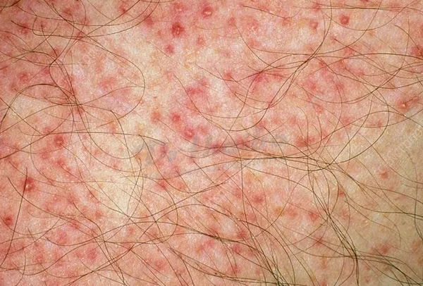 Viêm nang lông: Nguyên nhân, dấu hiệu và cách điều trị